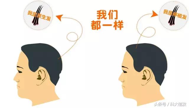 移植后的头发和正常头发有多大区别?