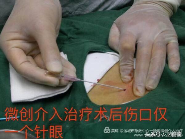 肝脏转移瘤用介入治疗有效吗,肝转移肿瘤介入治疗