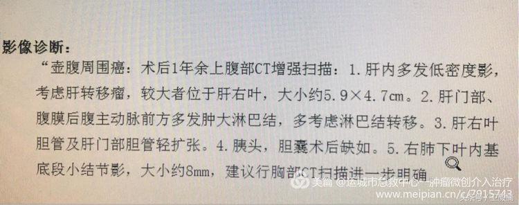 肝脏转移瘤用介入治疗有效吗,肝转移肿瘤介入治疗