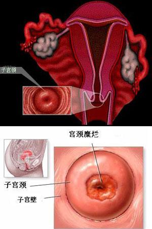 子宫糜烂已不是病了、姐妹们不要傻傻的还去做手术了