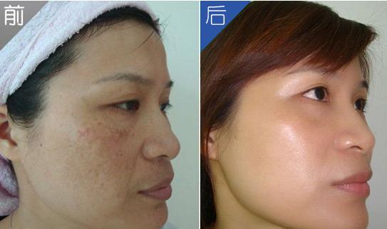 脸上长褐斑怎么快速消除,脸上大片褐斑怎么祛除