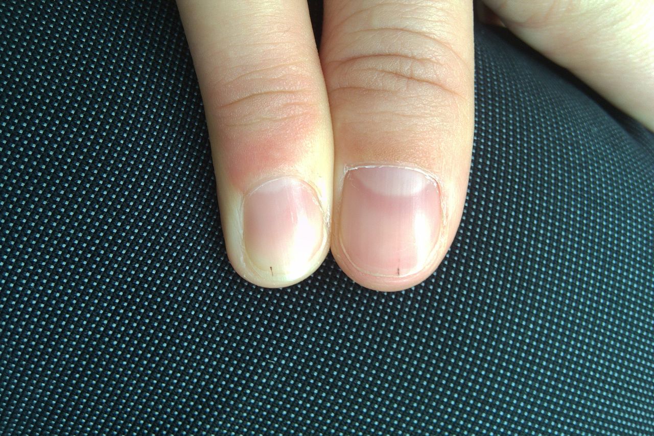 灰指甲会导致指甲变灰么,灰指甲指甲变颜色了怎么办