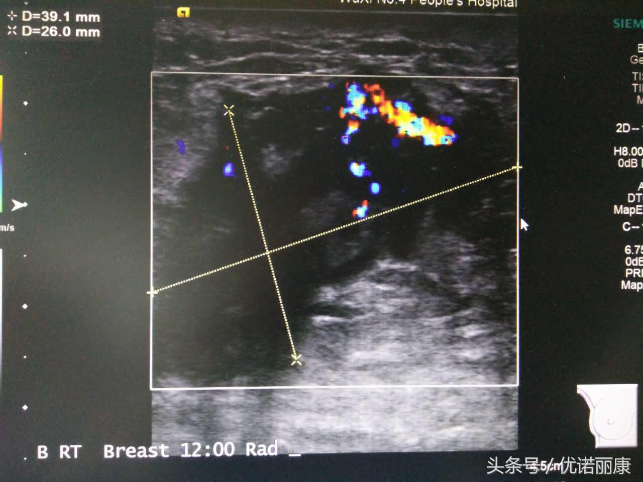 乳腺核磁共振报告专家解读,乳腺病检报告单怎么看