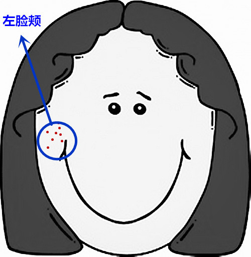 脸部痘痘看身体状况,超全面面部痘痘分析图文