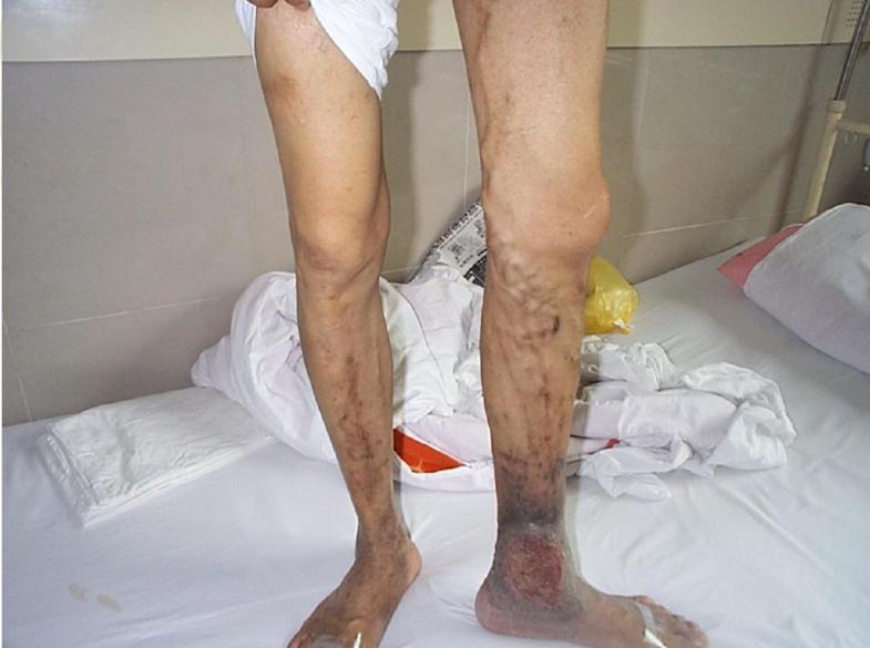 静脉曲张到底是什么？血管是不是很容易爆裂？容易溃疡？其实平时护理很重要，3个护理方法学起来，还你健康