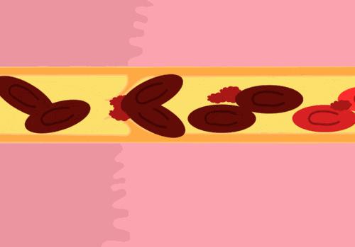 心血管堵了通血管有用吗,血管堵吃什么菜打通血管最快