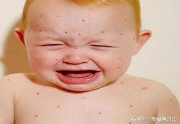 湿疹皮肤瘙痒不要慌用对方法,宝宝得了湿疹怎么处理好得快