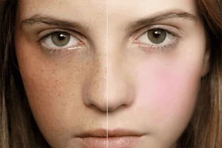 孕期如何避免长蝴蝶斑,孕期蝴蝶斑多久能消失