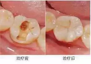 牙齿轻微缺损需要处理吗,牙齿楔状缺损修补多少钱