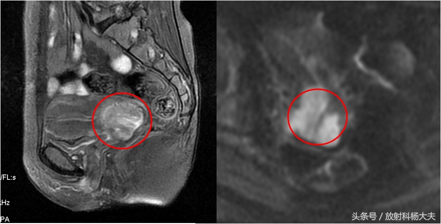 mr能查出宫颈癌早期吗,宫颈癌怎么从mr报告上看早晚期