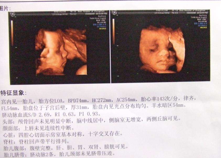 妊娠高血压生宝宝的孕妈,妊娠高血压剖腹产容易大出血吗