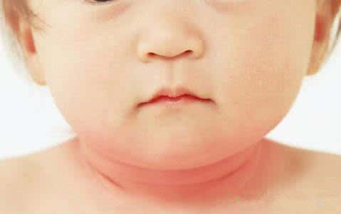 宝宝淹脖子的最佳治疗方法,宝宝淹脖子擦红霉素软膏还是眼膏