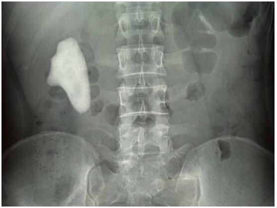 罕见！博锐医院取出像“7”又像“1”的巨大结石