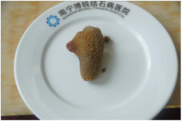 罕见！博锐医院取出像“7”又像“1”的巨大结石