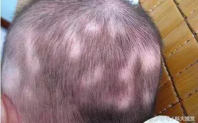 小孩不长头发,小孩不长头发怎么治疗