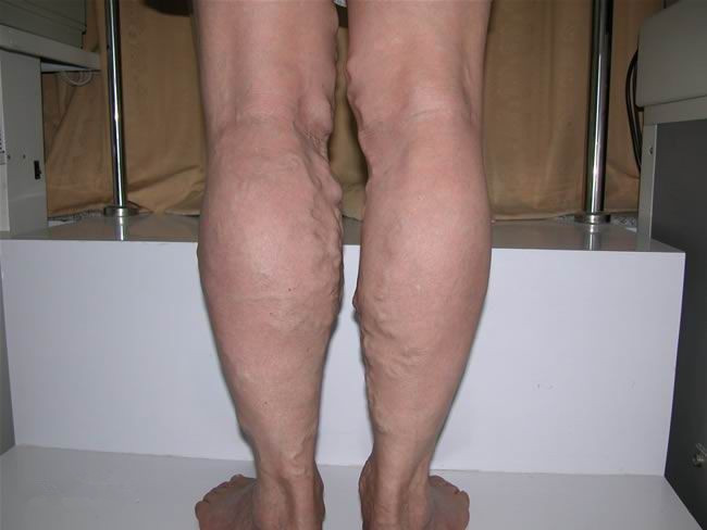 静脉曲张到底是什么？血管是不是很容易爆裂？容易溃疡？其实平时护理很重要，3个护理方法学起来，还你健康