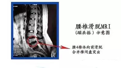一看就懂：高清视频详细解剖腰椎结构，腰椎各疾病