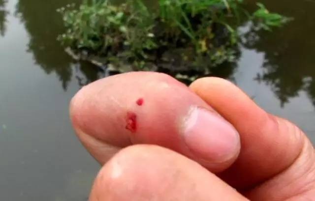 鱼钩刺肉如何处理,倒刺鱼钩钩进衣服怎么办