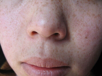 生孩子后脸色暗黄有斑怎么办,生孩子后长斑什么原因