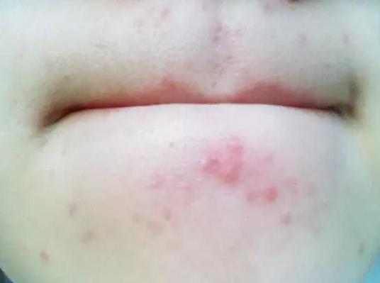 下巴反复长痘痘的原因和解决方法,下巴长期长痘痘的原因和解决方法