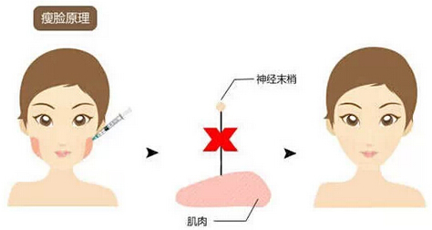 打完瘦脸针后悔了有什么办法,打完瘦脸针后悔了咋办