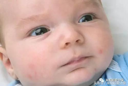 宝宝眼屎多便秘是怎么回事,宝宝眼屎多尿黄是怎么回事