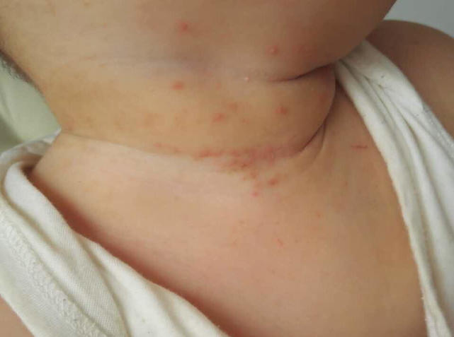 治疗婴儿痱子最快速有效的方法,宝宝头上的痱子治疗小妙招