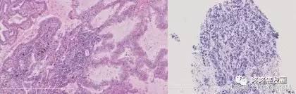 对AZD9291耐药的肺癌,到底该怎么办?