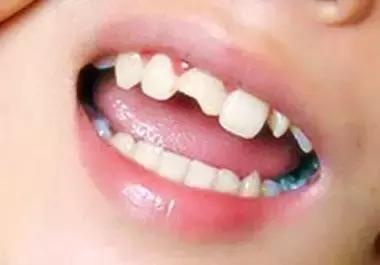 牙齿因外伤磕得快掉了该怎么办,牙齿摔坏了一半怎么办