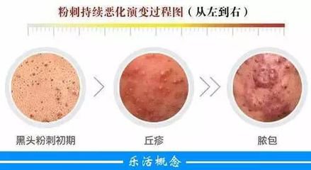 用手挤痘痘太用力皮肤变黑怎么办,用手挤痘痘的正确方法