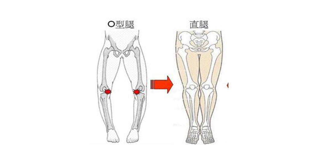跷二郎腿的腿变形了还有救吗,13岁二郎腿翘多了变形怎么改正