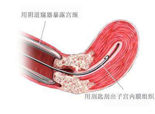 节育环真的万恶不赦吗,节育环放置不当会有哪些危害