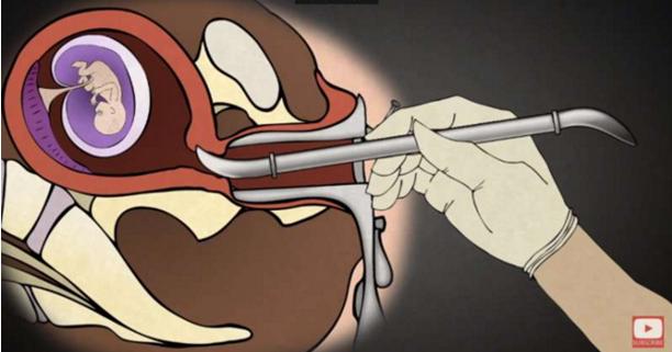 堕胎手术详细流程,女性堕胎手术的可怕真相