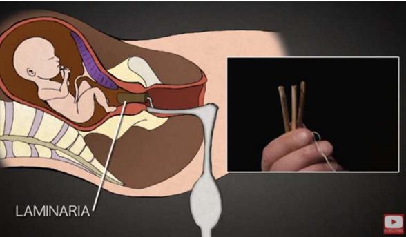 堕胎手术详细流程,女性堕胎手术的可怕真相