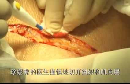 孕妇剖腹生下双胞胎惊呆医生,双胞胎出生过程实录