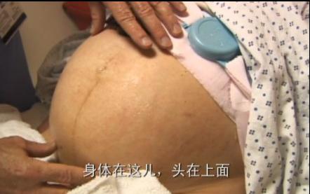 孕妇剖腹生下双胞胎惊呆医生,双胞胎出生过程实录