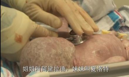 孕妇剖腹生下双胞胎惊呆医生,双胞胎出生过程实录