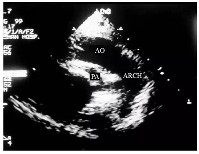 超声肺动脉瓣示意图,肺动脉左右分支超声视频