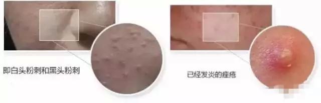 痘痘清洁护肤步骤,痘痘肌肤的最佳修复方法