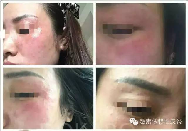 激素脸是什么病造成的,激素脸是什么症状