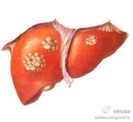 晚期肝癌的治愈率是多少,晚期肝癌的治疗好方法