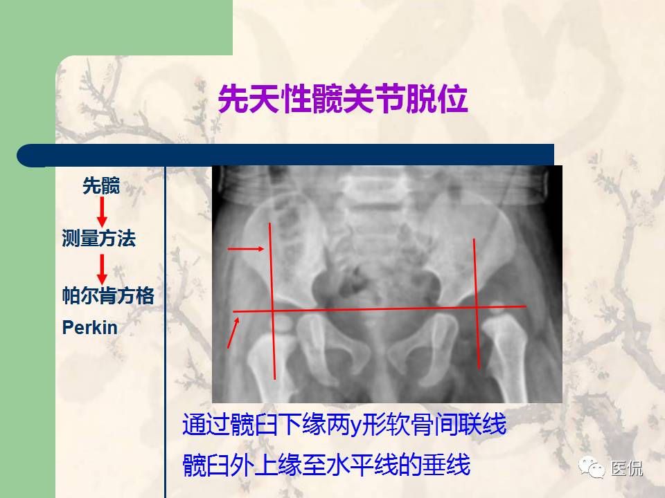 骨关节创伤x线诊断图谱,骨关节损伤x线图