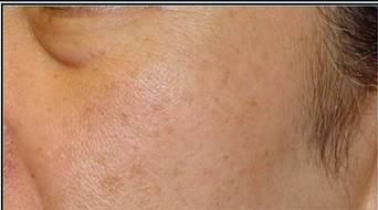 皮肤上的小肉疙瘩叫结节吗,皮肤上长了小肉疙瘩会癌变吗