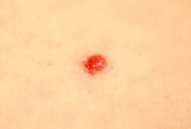 皮肤上的小肉疙瘩叫结节吗,皮肤上长了小肉疙瘩会癌变吗