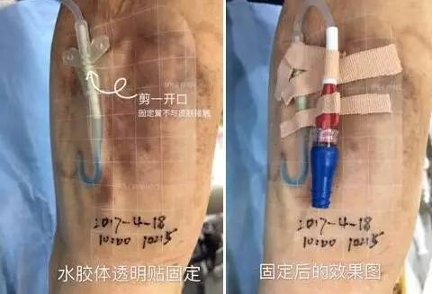 敷料致接触性皮炎，护士这样换药处理，效果极佳！