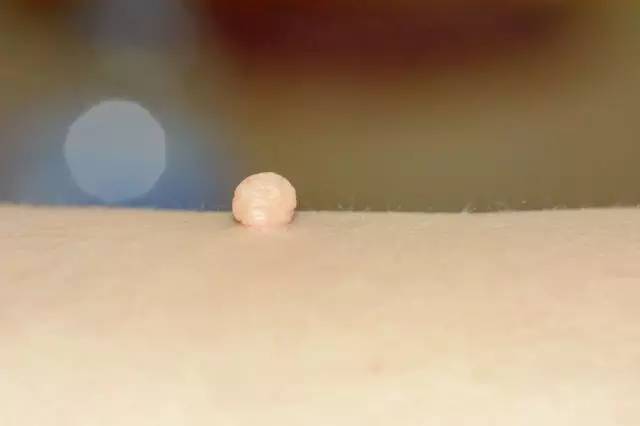 皮肤上的小肉疙瘩叫结节吗,皮肤上长了小肉疙瘩会癌变吗