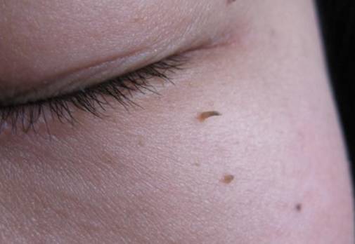 皮肤上的小肉疙瘩叫结节吗,皮肤上长了小肉疙瘩会癌变吗