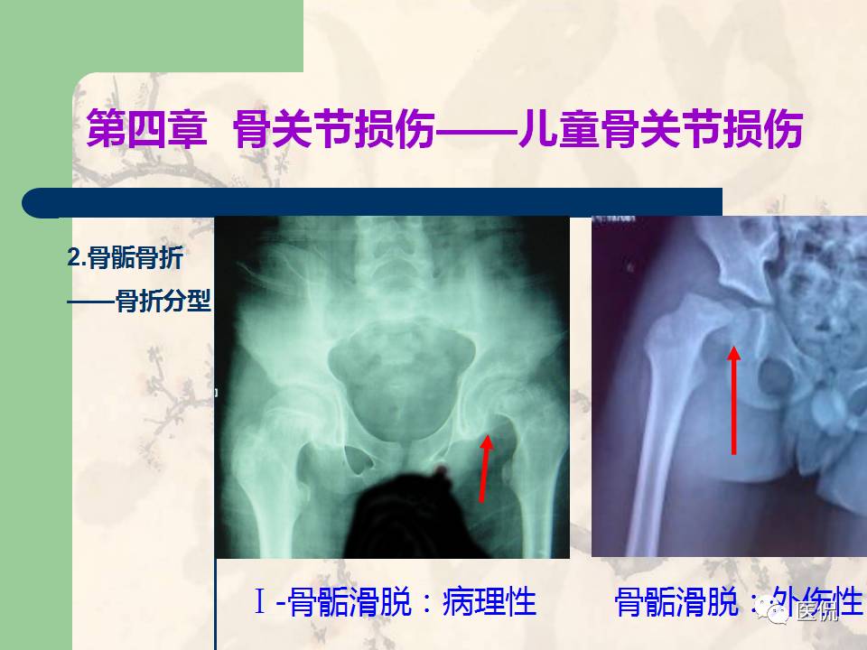 骨关节创伤x线诊断图谱,骨关节损伤x线图