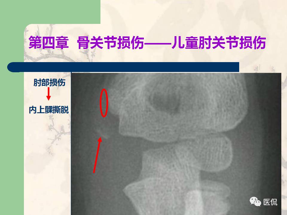 骨关节创伤x线诊断图谱,骨关节损伤x线图