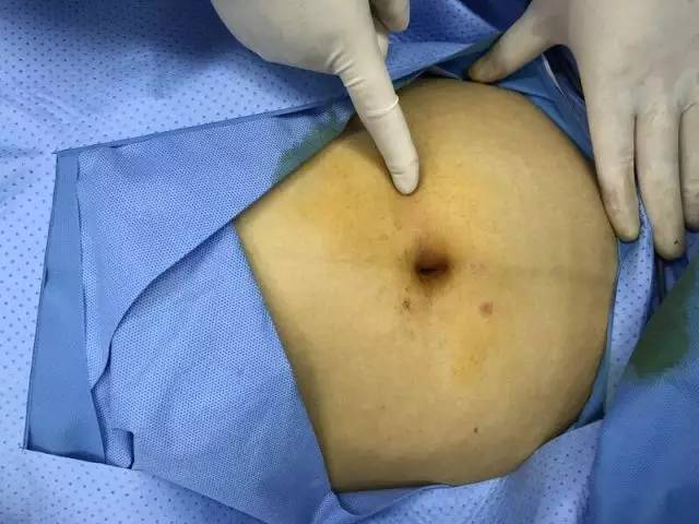 妇科无痕手术,医声